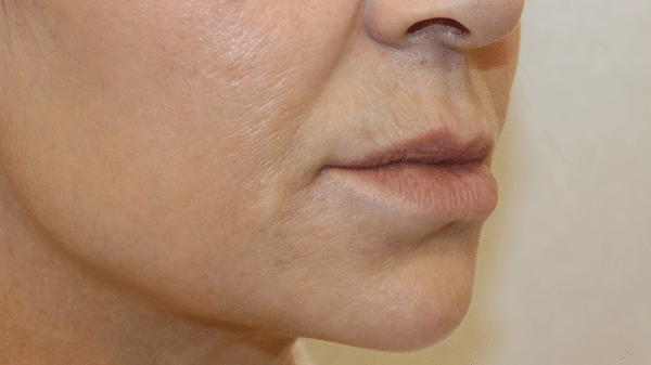 Face Procedures