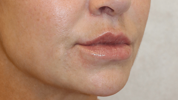 Face Procedures