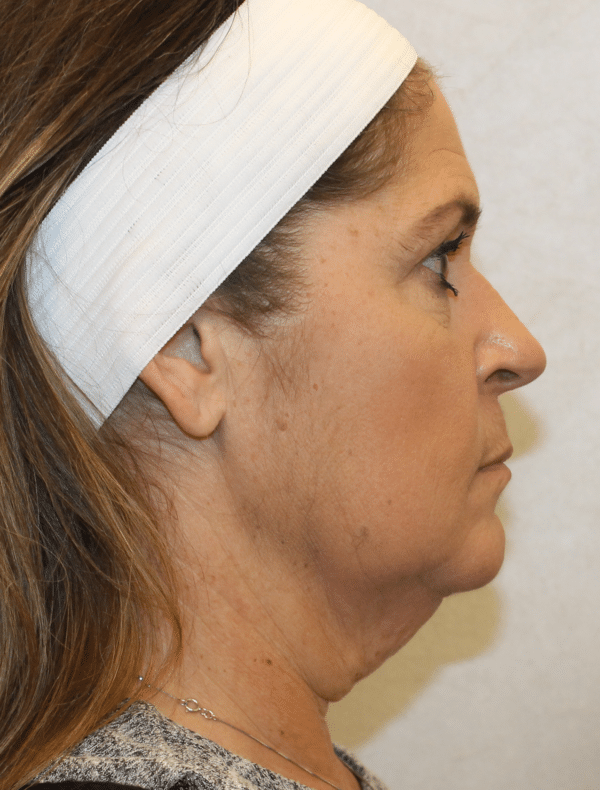 Facelift