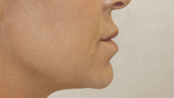 Face Procedures