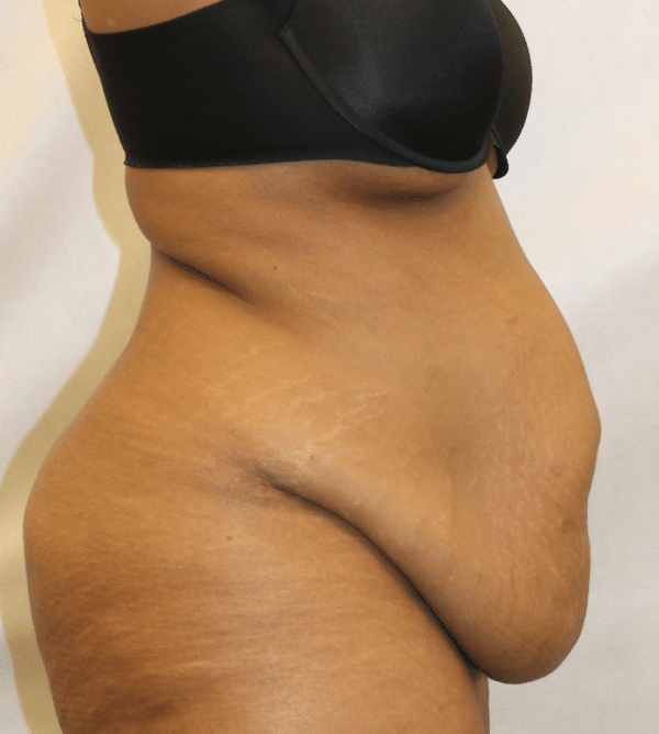 Body Procedures