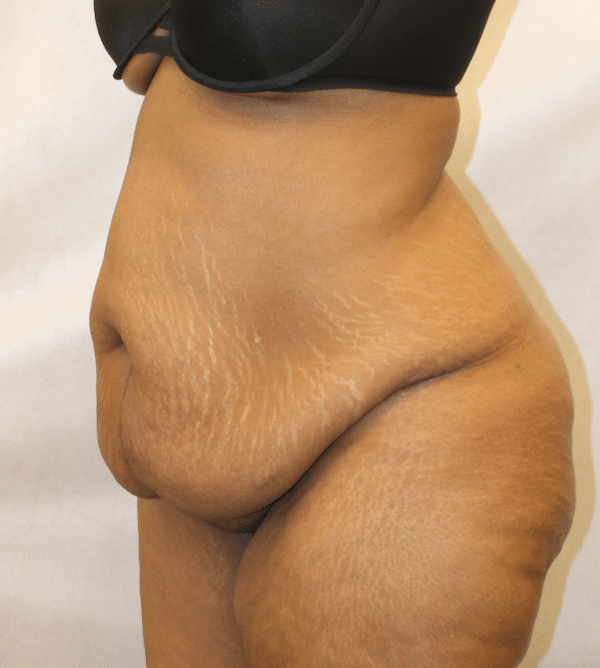 Body Procedures