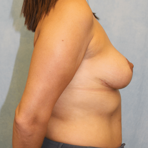 Breast Lift