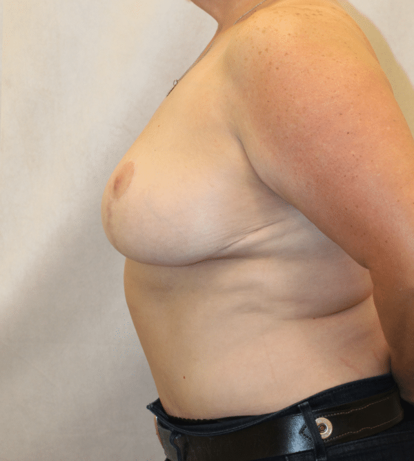 Breast Lift