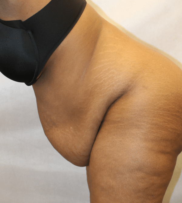 Body Procedures