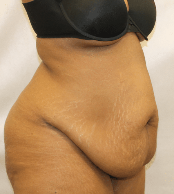Body Procedures