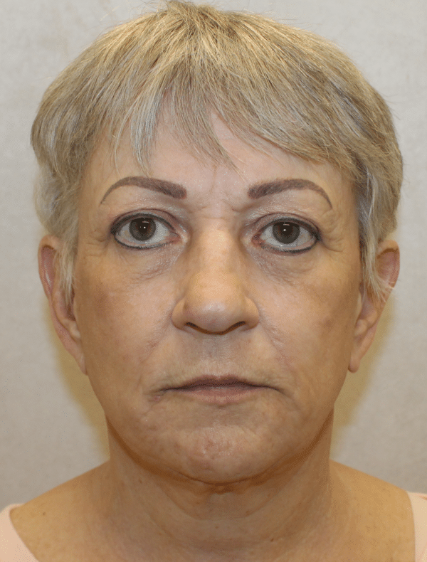 Facelift
