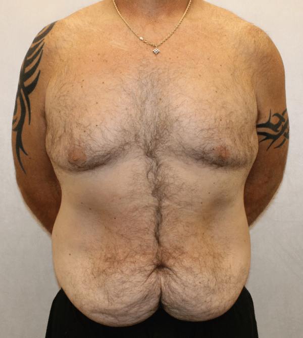 Body Procedures