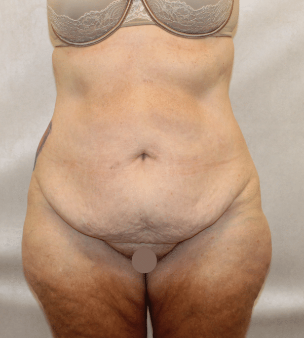 Body Procedures