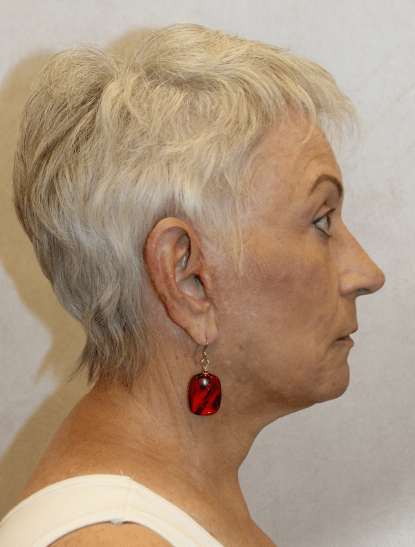 Facelift