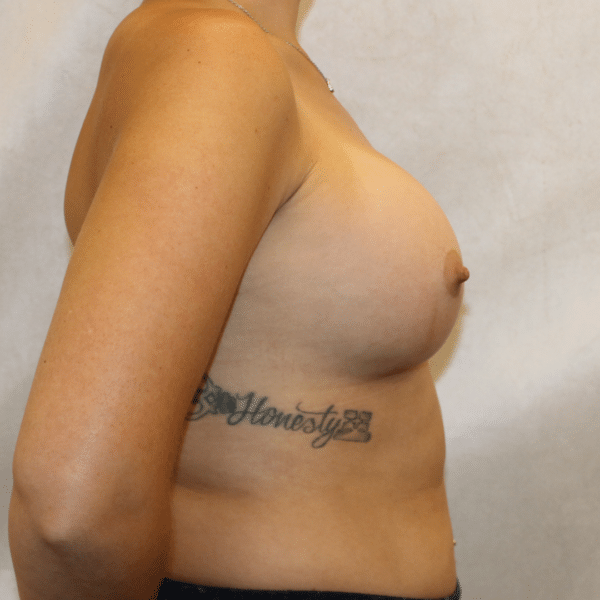 Breast Augmentation