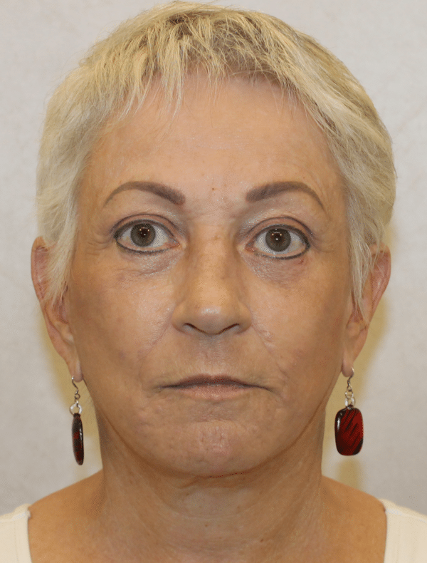 Facelift