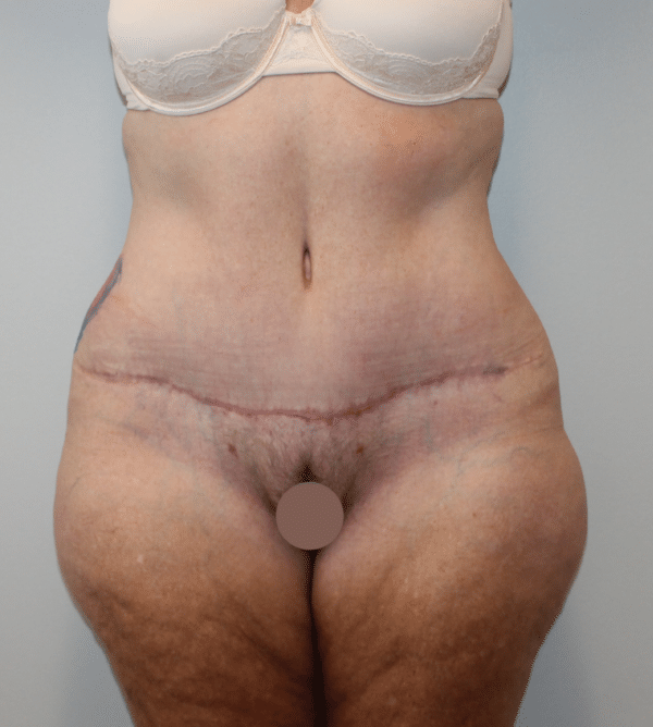 Body Procedures
