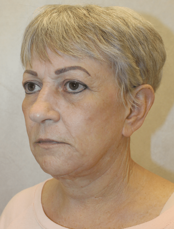 Facelift