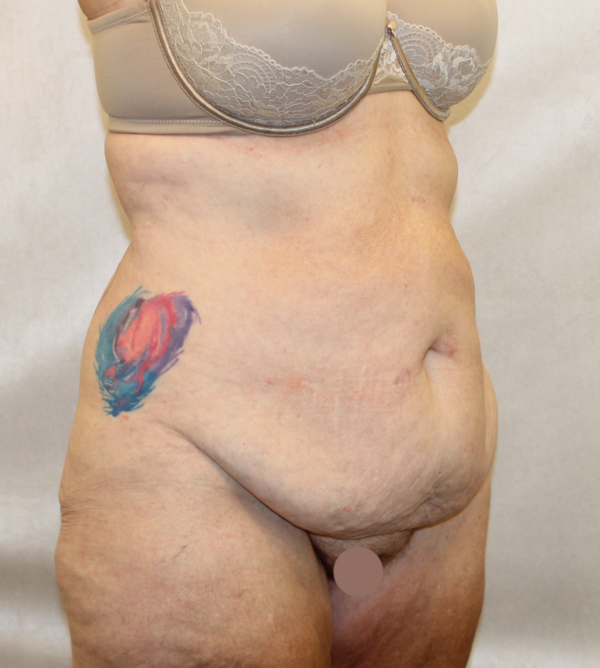 Body Procedures