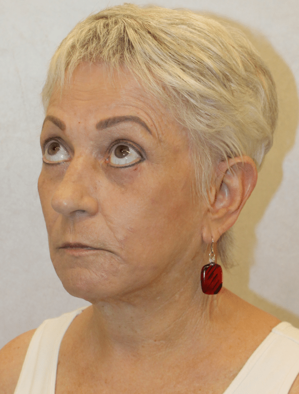 Facelift