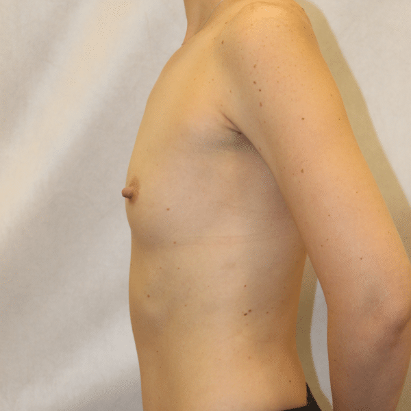 Breast Augmentation