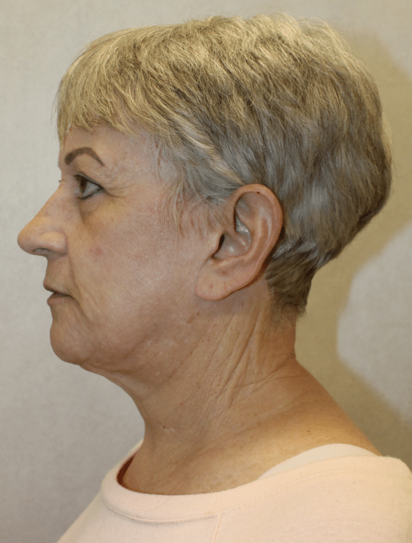 Facelift