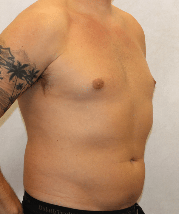 Liposuction