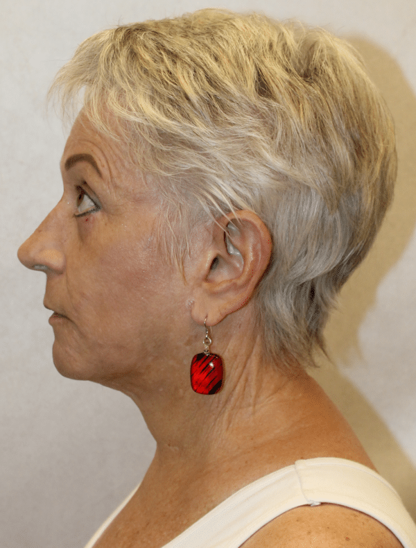 Facelift