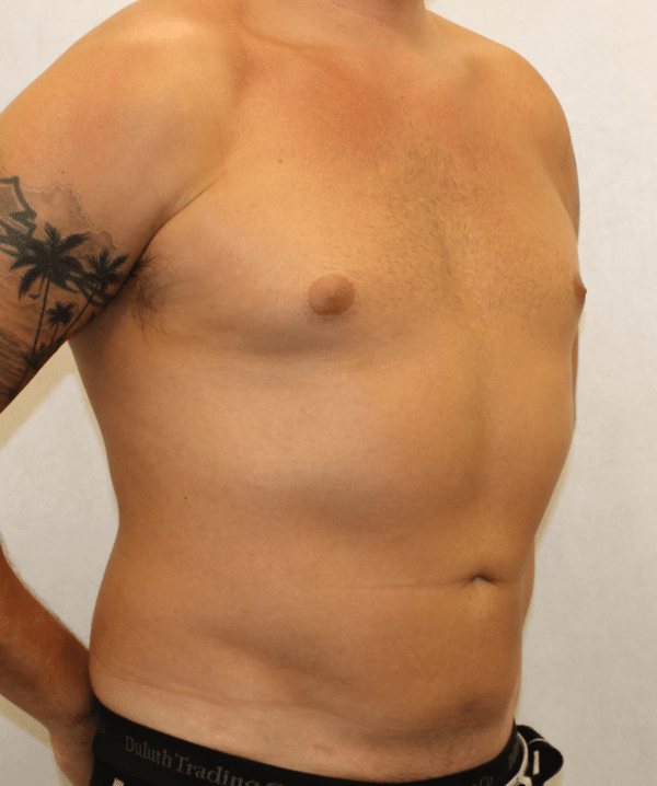 Liposuction