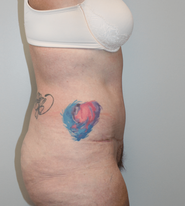 Body Procedures