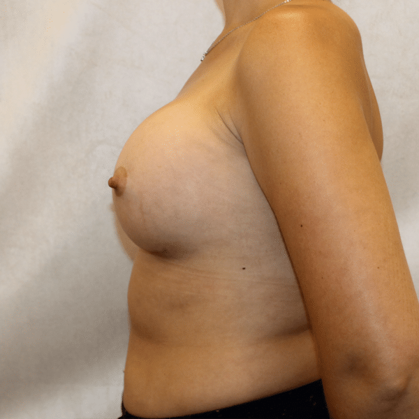 Breast Augmentation