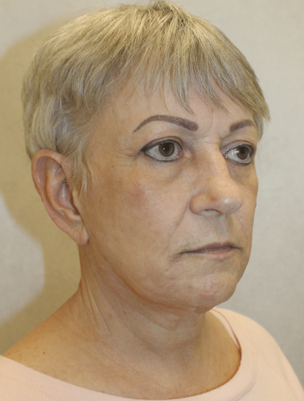 Facelift