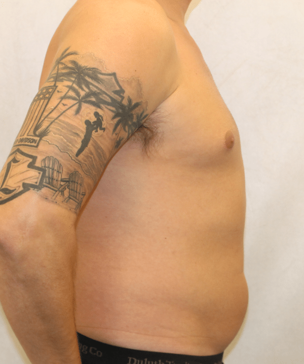 Liposuction