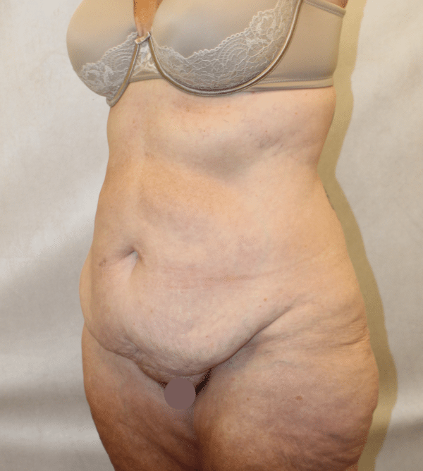 Body Procedures