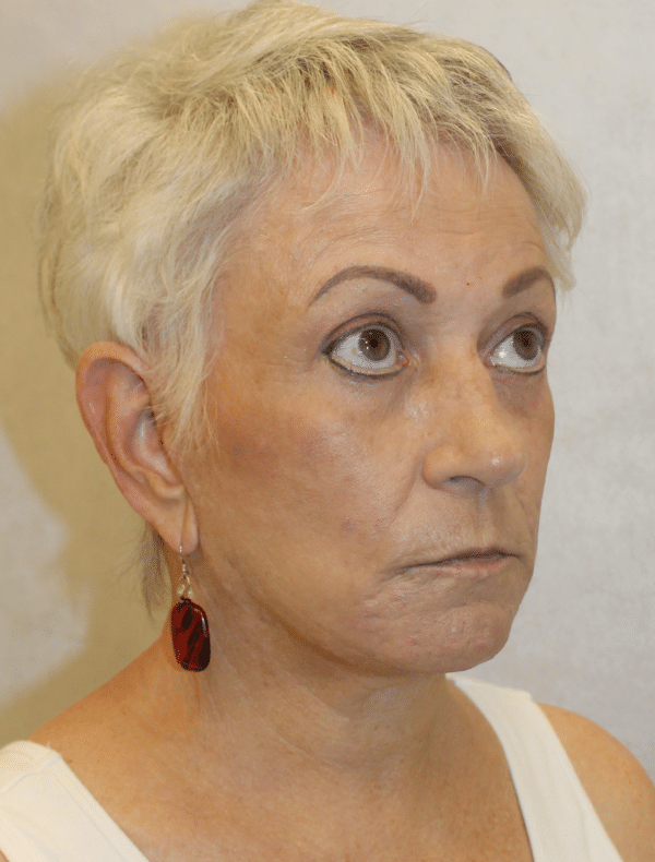 Facelift