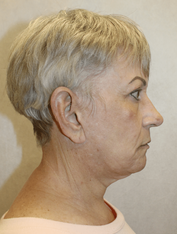 Facelift