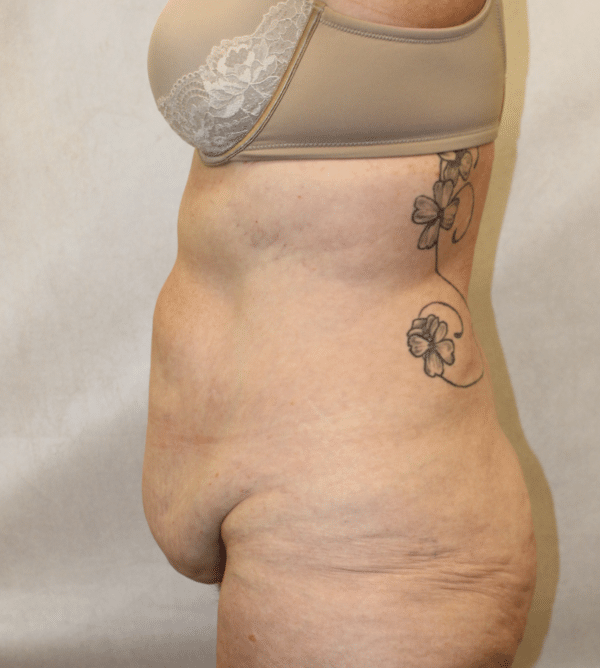 Body Procedures