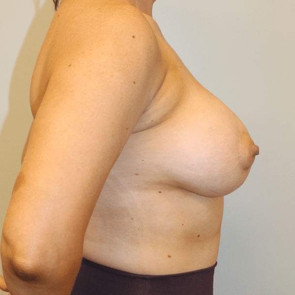 Breast Lift with Implants