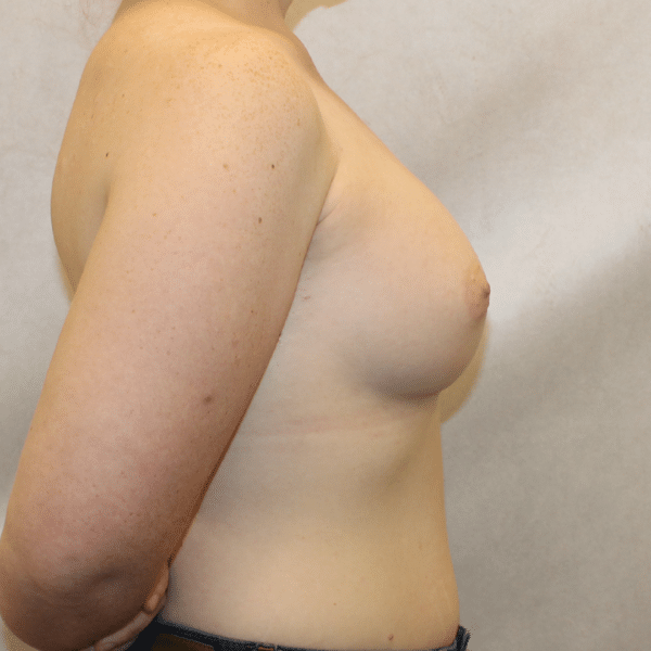 Breast Augmentation
