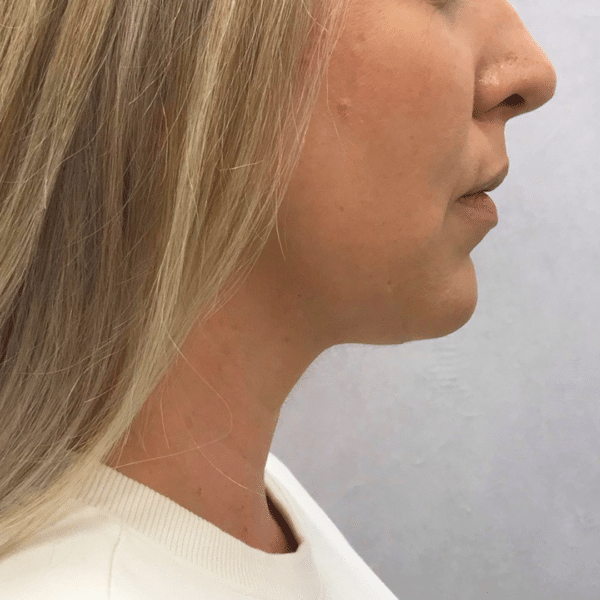 Face Procedures