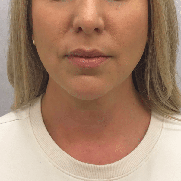 Face Procedures