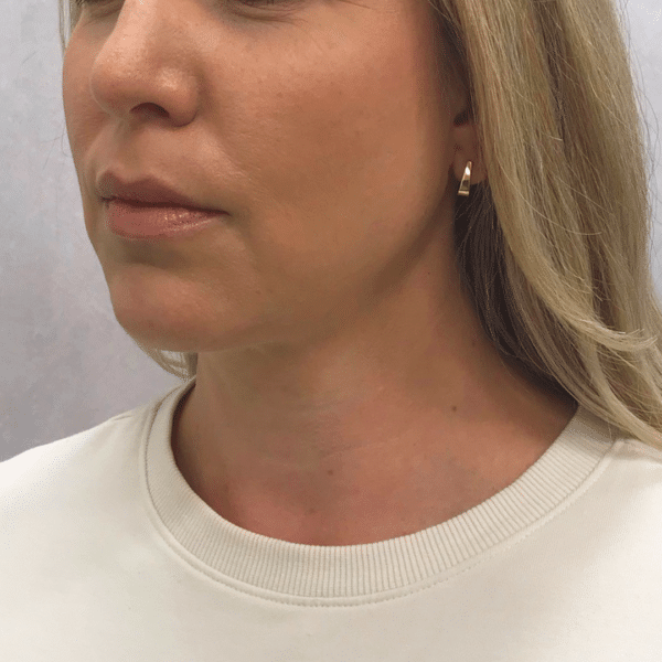 Face Procedures