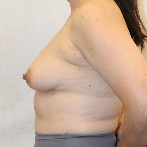 Breast Lift with Implants
