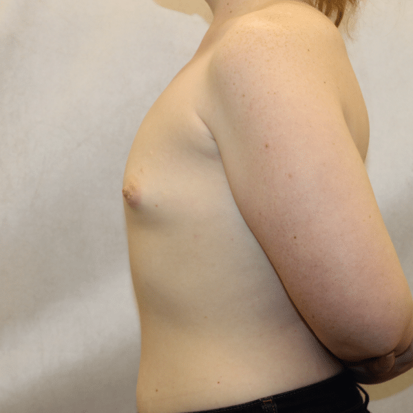 Breast Augmentation