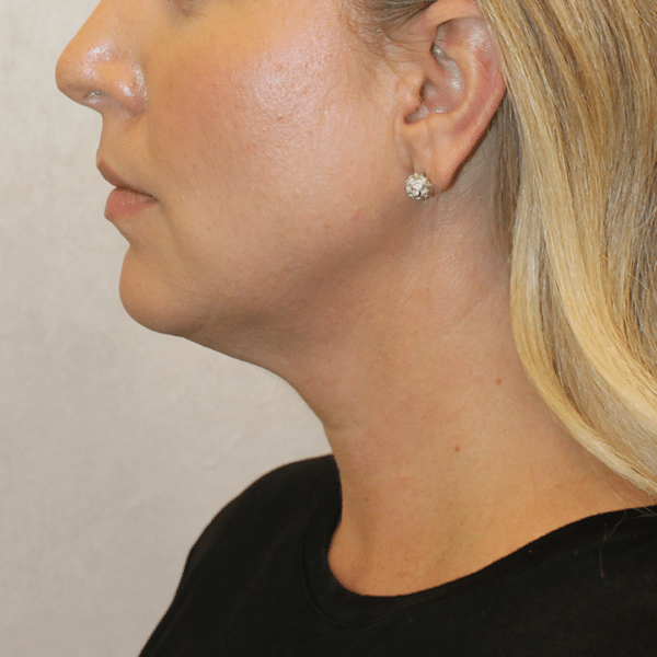 Face Procedures