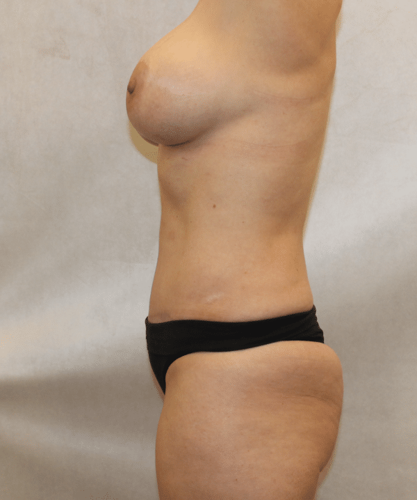Liposuction