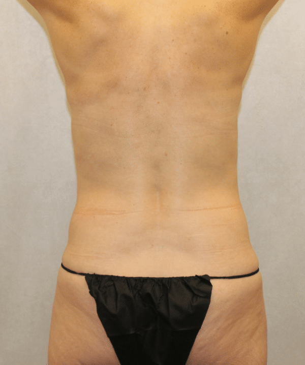 Liposuction
