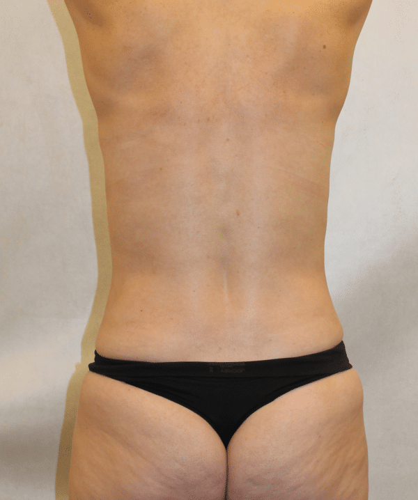Liposuction