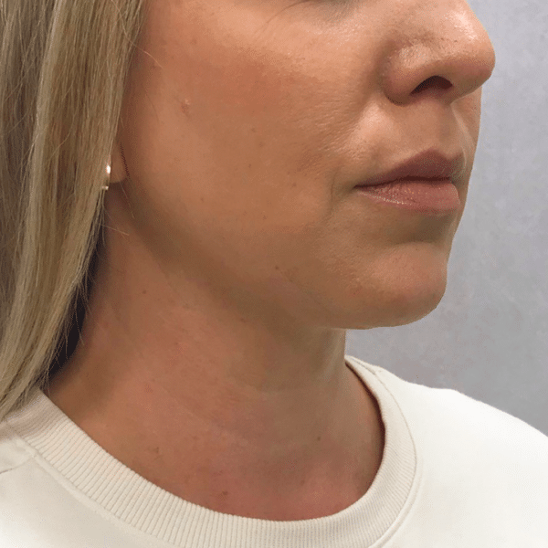 Face Procedures