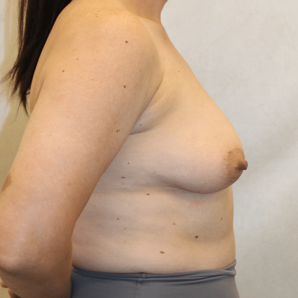 Breast Lift with Implants