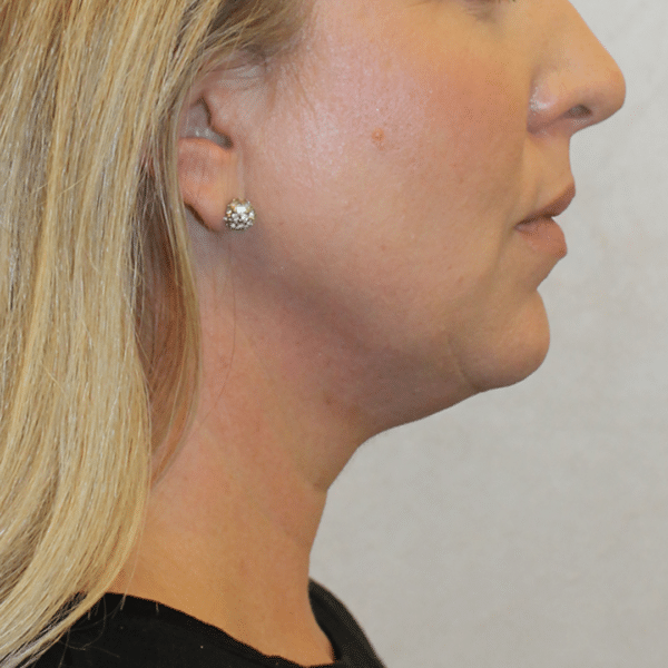 Face Procedures