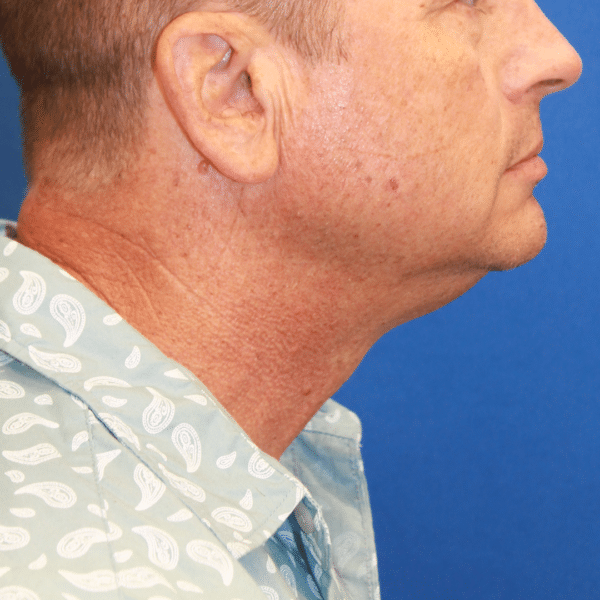 Face Procedures