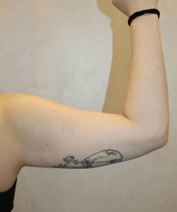 Liposuction