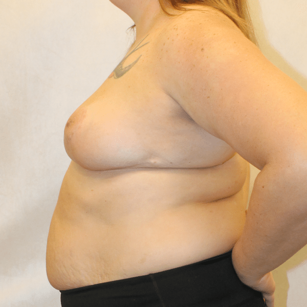 Breast Lift